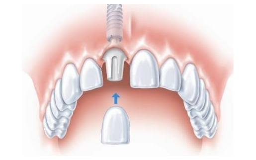 <b>What are the differences between denture and implant?</b>