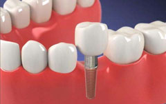 How can dental implants be used for a long time?