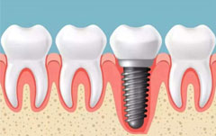 <b>Dental implant</b>