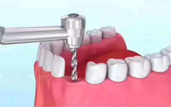 HOW PAINFUL IS GETTING A DENTAL IMPLANT?