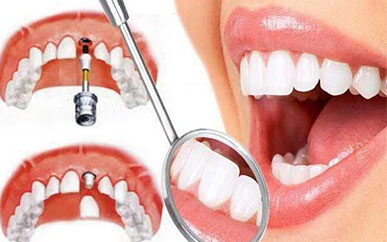 <b>Single-tooth implant</b>