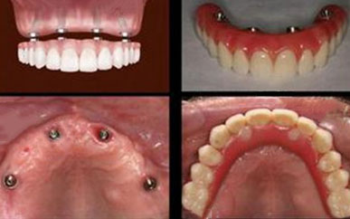 <b>Single-tooth implant</b>