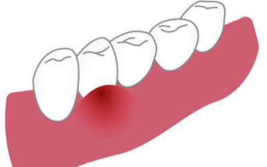 <b>Typical signs of periodontal disease, have you caught it?</b>