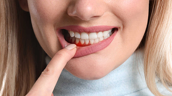 علاج دواعم السن