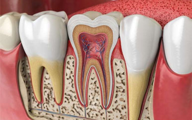 How is root canal therapy performed?