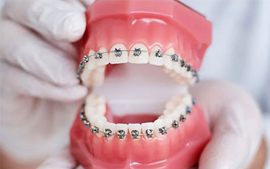 How much do you know about orthodontic metal braces?