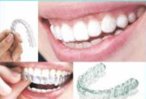 Clear Aligners