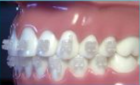 Lingual Invisible Braces