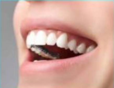 Metal Self-Ligating Braces