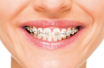 Ceramic Self-Ligating Braces